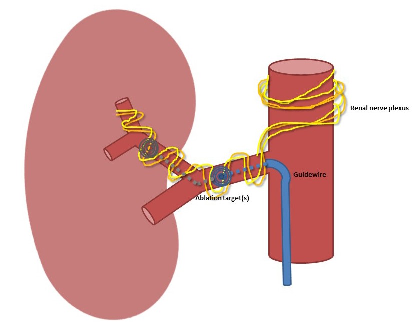 Renal nerve ablation for resistant hypertension facts, fictions and